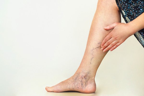 How to Get Rid of Varicose Veins: 9 Home Remedies That Work