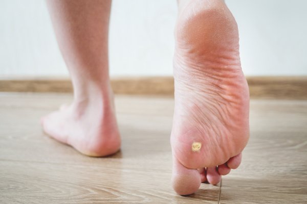 Home Remedies that Work: 7 Natural Treatments for Plantar Warts
