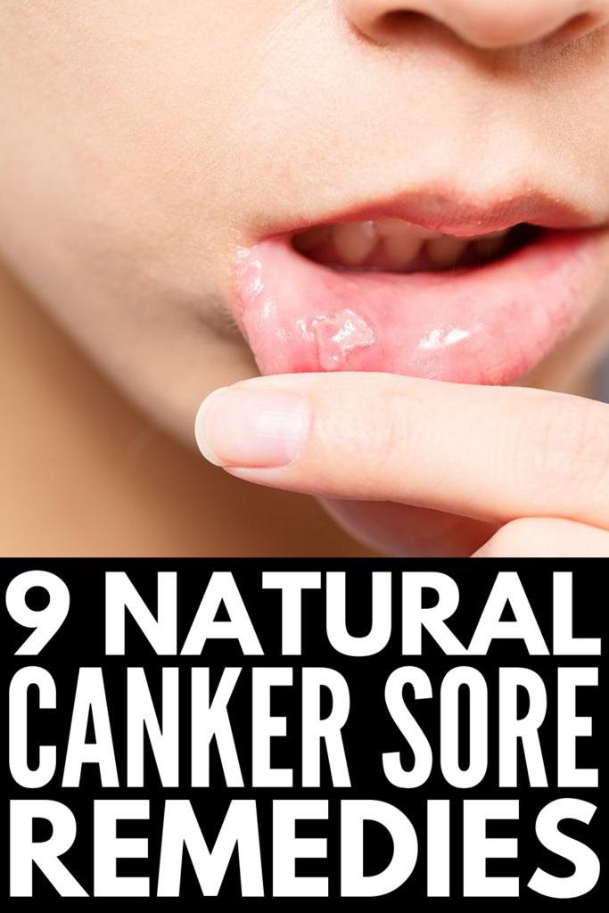 9 Canker Sore Remedies | Canker sores and ulcers in the mouth are not fun, especially for kids! Whether you have a canker sore on your lips, cheeks, gums, tongue, or even in your throat (ouch!), one thing is for certain: you want fast acting relief! This post has tons of useful tips, including information on what causes canker sores, how to prevent canker sores, and quick home remedies for canker sores for toddlers, older kids, and adults. 
