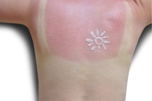 Too Much Sun! 8 Natural Sunburn Remedies That Work Fast