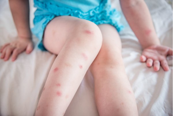 Stop The Itch! 9 Natural Mosquito Bite Remedies that Work