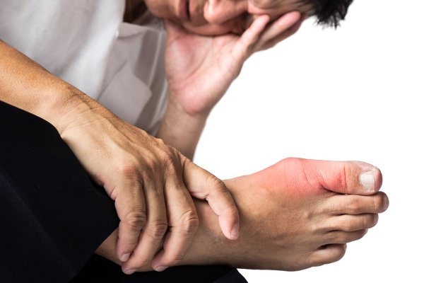 7 Gout Remedies to Prevent and Relieve Pain Quickly