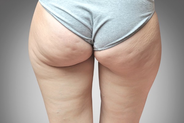 7 Proven Ways to Get Rid of Cellulite Fast For a Sexy Body