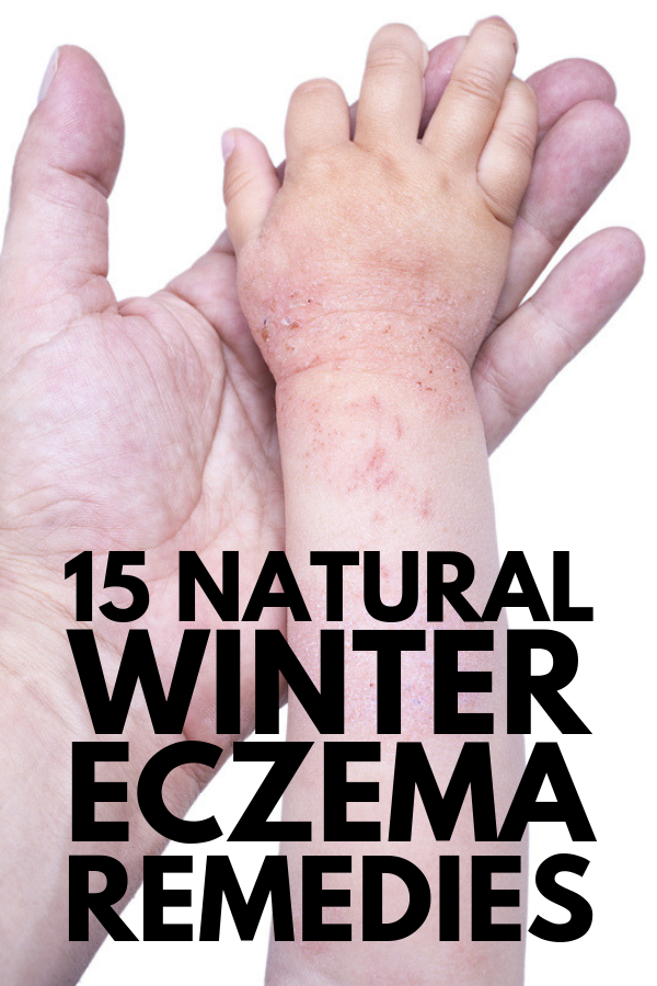 How to Relieve Eczema | Whether you or your children have extremely dry skin or full-blown eczema or psoriasis, we’re sharing our favorite natural skin care tips, home remedies, clothing for eczema, and other products we swear by to prevent eczema flare-ups and help reduce itching and inflammation when your eczema is active. #eczema #eczematreatment #eczemahomeremedies #eczemacure
